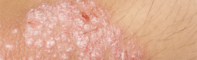 Psoriasis
