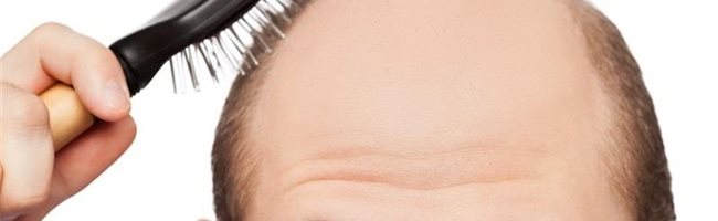 Alopecia