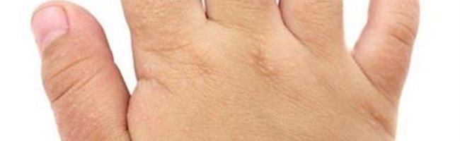 Dermatitis atópica